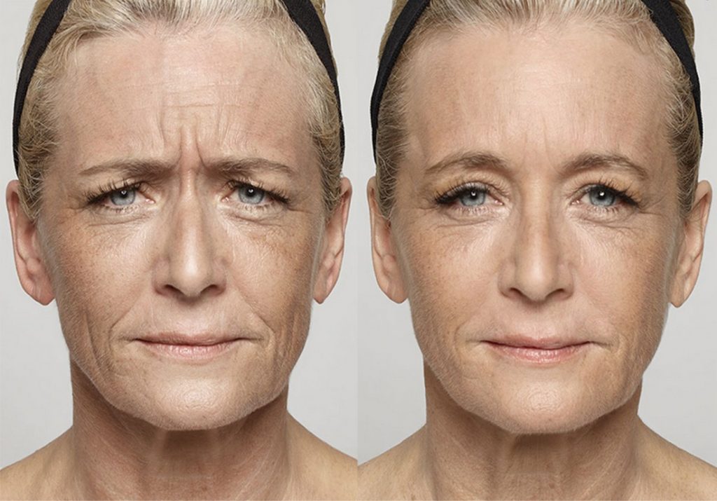wrinkles disappear before your eyes